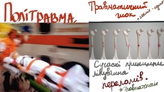 Політравма. Травматичний шок - клініка, діагностика, лікування. Сучасні принципи лікування переломів