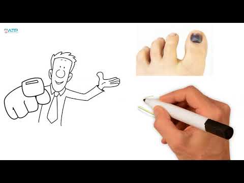 Prevent protect black bruised toenails with Aamzing Toe Pads Prevent protect black bruised toenails with Aamzing Toe Pads