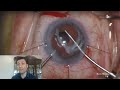 how to dissect and explant the ctr in a dislocated ctr iol capsular bag complex dr rami shasha md