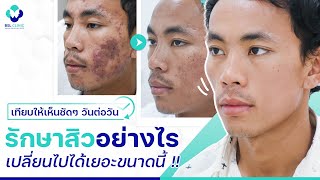 รักษาสิว | โครงการรักษาสิวฟรี Season 2 | EP.1 | สิว เยอะขนาดนี้ รักษาสิวอย่างไร | BSL Clinic