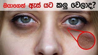 ඇස් යට කලු වෙන්නෙ ඇයි? ප්‍රතිකාර මොනාද?😨| What causes Dark Circles Under Eyes ?