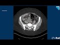 multimodality appearance of adnexal torsion part 1 15 minute radiology cme