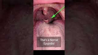 ENT strange factoids. The “It is abnormal!” But is actually normal epiglottis #shorts @fauquierent