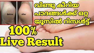 Live result 100% | വിണ്ടു കീറിയ പാദങ്ങൾ മിനിറ്റുകൾക്കുള്ളിൽ പഴയത് പോലെ | home remedy cracked heels