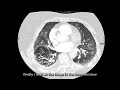 how to read ct pulmonary angiogram ctpa