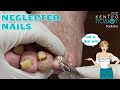 Neglected Nails|Παραμελημένα νύχια|nails|Κέντρο Ποδιού Podiatry|Ποδιατρική|Ποδίατρος|podiatrist|corn
