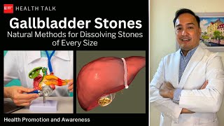 Bato sa apdo: May pagasa pa bang malusaw sa natural na paraan? Gallbladder stones