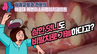 해운대교정치과 심한 덧니, 비발치 교정 가능!