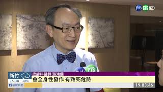 冬天乾癬好發季 求診患者增加2成 | 華視新聞 20191201