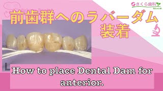 前歯部へのラバーダム。How to place Dental Dam for anterior.