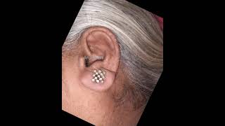 Ear Lobe Repair |காது hole சரிசெய்ய permanent treatment at Arumeen Aesthetic Centere- Dr.A.Saravanan