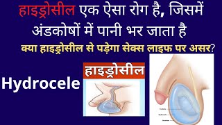 Hydrocele. Testicular Swelling and Pain. अंडकोष में दर्द Dr.(Prof)Santosh Kumar PGI