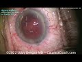 cataractcoach 1566 the ocular surface and cataract surgery