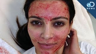 Kim Kardashian's Blood Facial