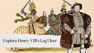 All You Need to Know About Henry VIII's Ulcerated Leg.