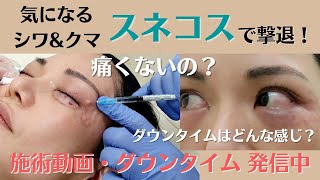 スネコス施術動画\u0026ダウンタイム