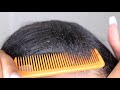 dry flaky scalp dandruff scratching picking combing big flakes huge scales up close asmr