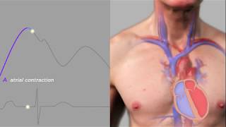 Easy Measurement of Jugular Venous Pressure