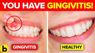 Early Warning Signs of Gingivitis You Should Not Ignore