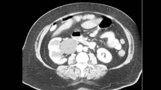 CT Abdomen Pelvis Chronic UPJ Obstruction Discussion by Radiologist