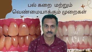 பல் கறை மற்றும் வெண்மையாக்கும் முறைகள் / Teeth stains and whitening methods