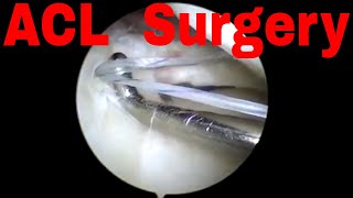 Arthroscopic ACL reconstruction with meniscus repair - Dr. Anant Joshi Mumbai, India