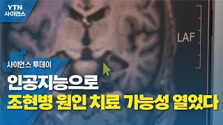 인공지능으로 조현병 원인 치료 가능성 열었다 / YTN 사이언스