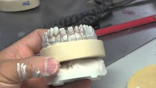 IPS eMax Veneers Product Video