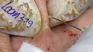 BLACKHEADS REMOVAL (309_2) | Loan Nguyen