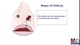 Can Cleft Lip Be Repaired