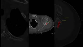 CT of Chronic Shoulder Dislocation #meded #sportsmedicine #radiology #orthopedics