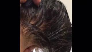 Details of Non Surgical Hair Replacement in Dubai - Part 2