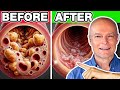 Top 10 Best Vegetables To Unclog Arteries Naturally & Prevent Heart Attack