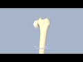 hip fractures