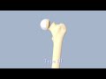 Hip Fractures