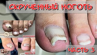 Скрученные ногти - \