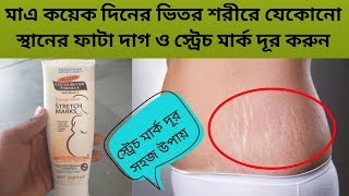 Stretch Marks Massage Cream Use In Bangla || প্রসারিত চিহ্ন দূর করার কার্যকারী উপায়