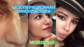 МОЙ ОПЫТ | БЕЗОПЕРАЦИОННАЯ РИНОПЛАСТИКА - ЗА ИЛИ ПРОТИВ