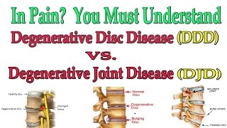 In Pain?  You Must Understand Degenerative Joint Disease vs Degenerative Disc Disease - Dr Mandell