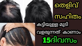 ദിവസങ്ങൾക്കുള്ളിൽ Thick HairGrowth|മുടി ഇല്ലാത്ത തല മണ്ടയിൽ മുടി വളരും