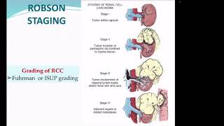 Renal cell carcinoma ( RCC part 3; TNM staging & Management)