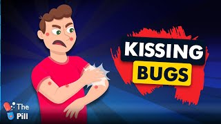 What are kissing BUGS and why you shouldn't let them Kiss you?