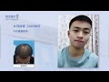 頭頂加密手術效果太好，大陸髪友術後公開分享！yonghe hair transplant