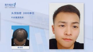 頭頂加密手術效果太好，大陸髪友術後公開分享！Yonghe hair transplant