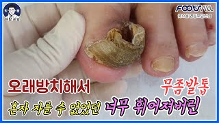 귀신발톱 처럼 휘어버린 무좀발톱 , 혼자 관리하기 어려웠던 발톱 fungus toenail [풋스올영등포당산점]