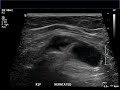 spigelian hernia reduction ultrasound