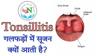 Tonsillitis / Inflammation of Tonsils / Infection of Tonsils - टॉन्सिल क्या है? जानिये कारण और इलाज!