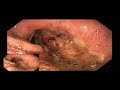 large bleeding gastro jejunal anastomotic ulceration after gastric bypass