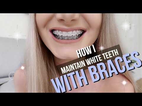 How I Keep My Teeth White With Braces How I Keep My Teeth White With Braces