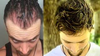 How I Quit The World’s Best Hair Loss Treatment and Regrew My Hair Naturally | Connor Murphy